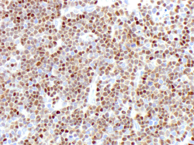 Lymph node biopsy shows that the neoplastic cells are positive for TdT (400x).